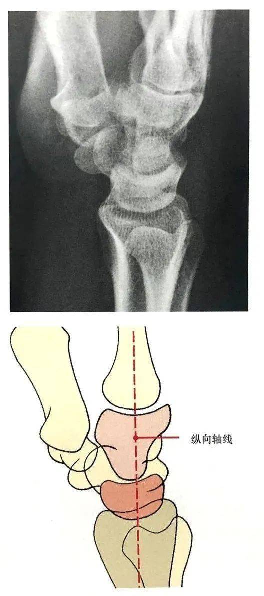 在腕关节中立位侧位片上显示桡骨,月骨,头状骨和第三掌骨的长轴呈直线