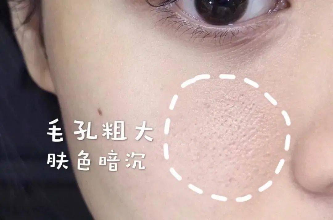 贫民窟|杨幂熬夜后护肤要花2万块？怪不得皮肤吹弹可破！贫民窟女孩就不配消除熬夜痘、黑眼圈吗？