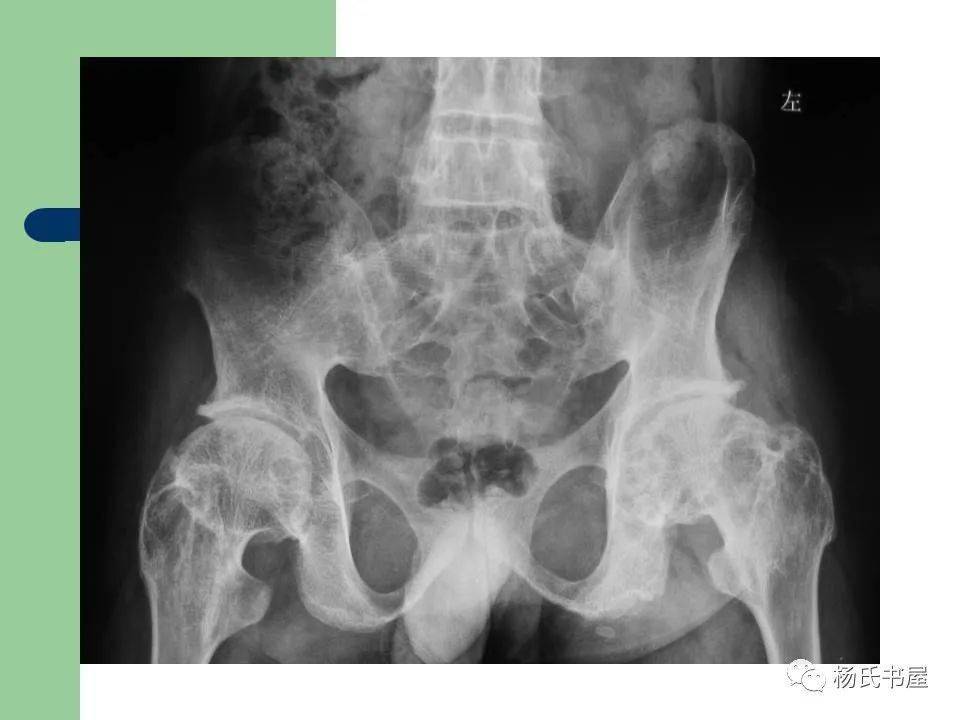 骨质疏松多久见效果 492ad7b5f3cc48f681049e5f3d5fda18.jpeg