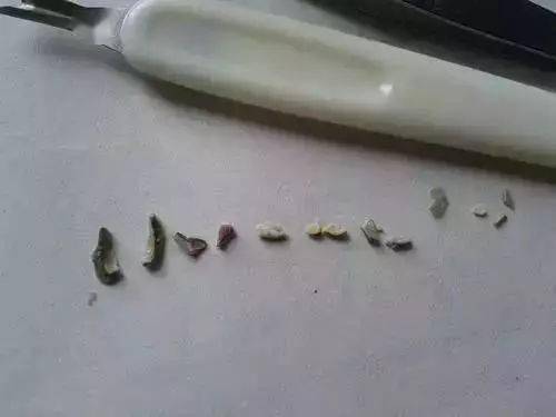 某论坛一女汉纸发帖,称自己闲来无事把累积20多年的牙结石给抠下来了