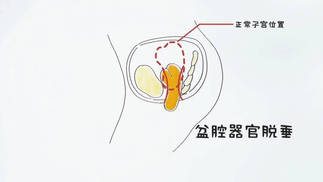 根据不同的发生部位,女性的盆腔脏器脱垂可分为阴道前壁脱垂,子宫