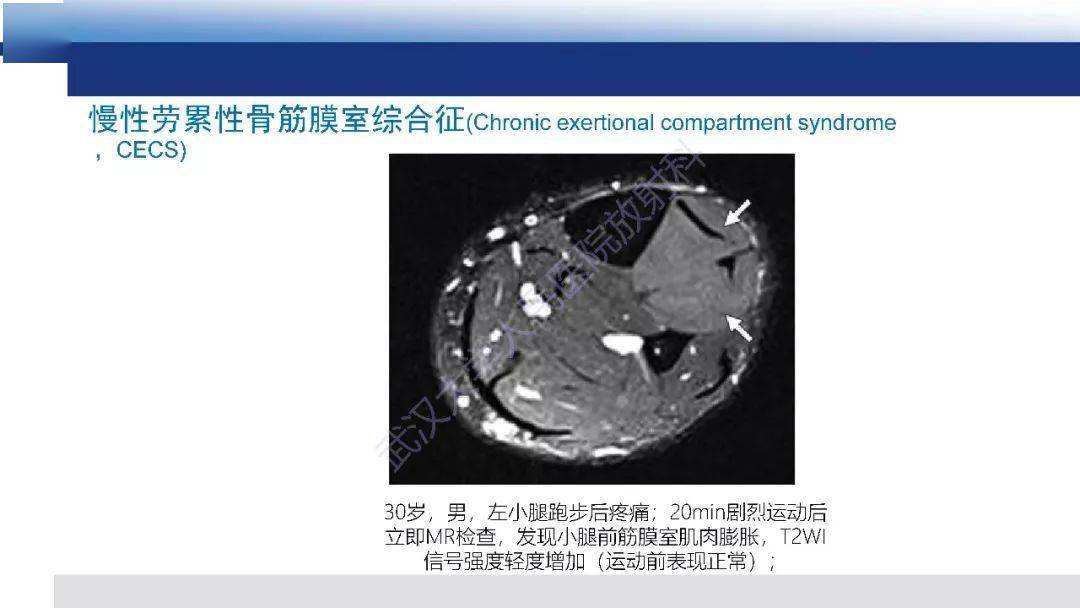 肌肉创伤mr诊断:解剖,生物力学,病理生理学及影像学表现