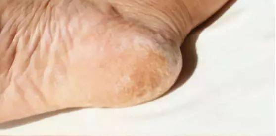 日本|日本黑科技泡脚汤药,竟让全民女人1个月瘦20斤!暴汗排湿还嫩肤助眠!