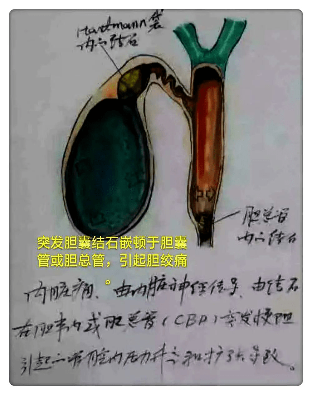 胆结石什么原因造成的呀 6d059cd0d9914e418f829fa095364b91.png