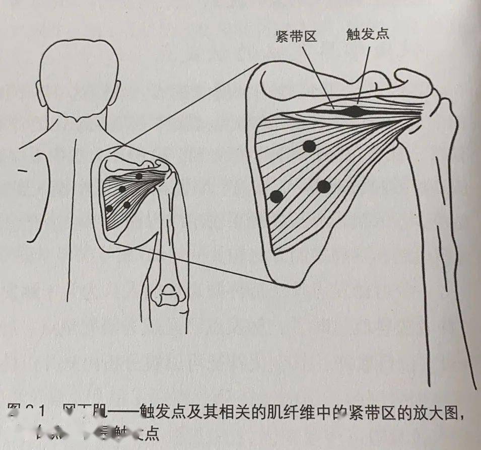 触发点疗法手法详解,21个部位完全覆盖,精准解决疼痛问题!