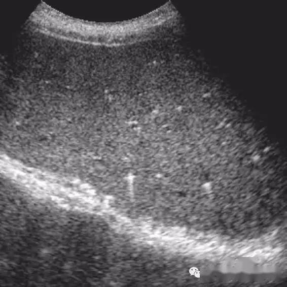 超声随响第11期胆管错构瘤