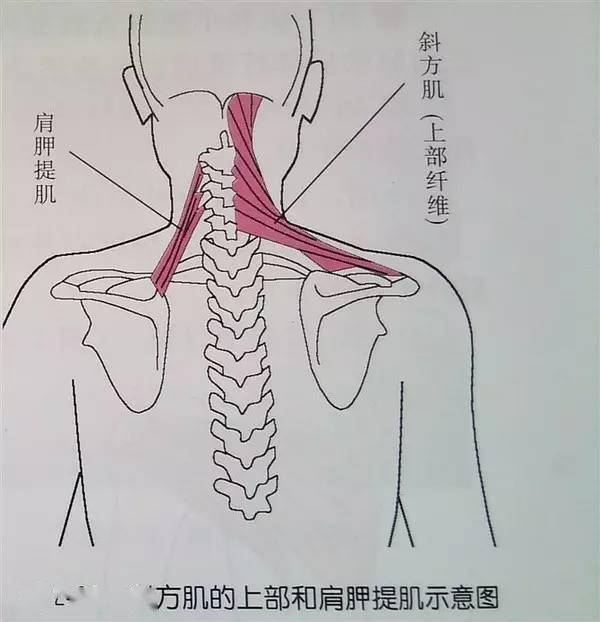 松解的位置就在箭头指的位置,找到斜方肌上部的痛点,按摩.