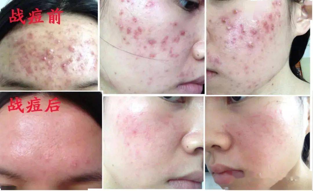 张天|长期闭口、粉刺、痘痘满脸的人，微镜头下毛孔竟然是这样的！赶紧get林允、张天爱的0毛孔秘籍吧！