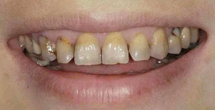 牙齿为什么会变黄?常用的美白方式了解一下
