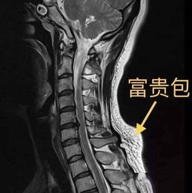 脖子背后的"富贵包"是怎么回事?如何消除?医生教您6招