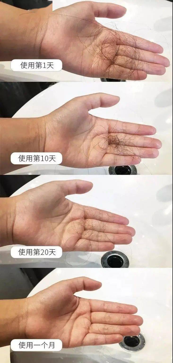 索芙特|超强国货生发!1个月发际线被填满,半年发量暴增!
