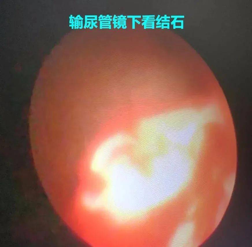 同仁精品外科钬激光碎石2李晓奇主任治疗肾输尿管结石