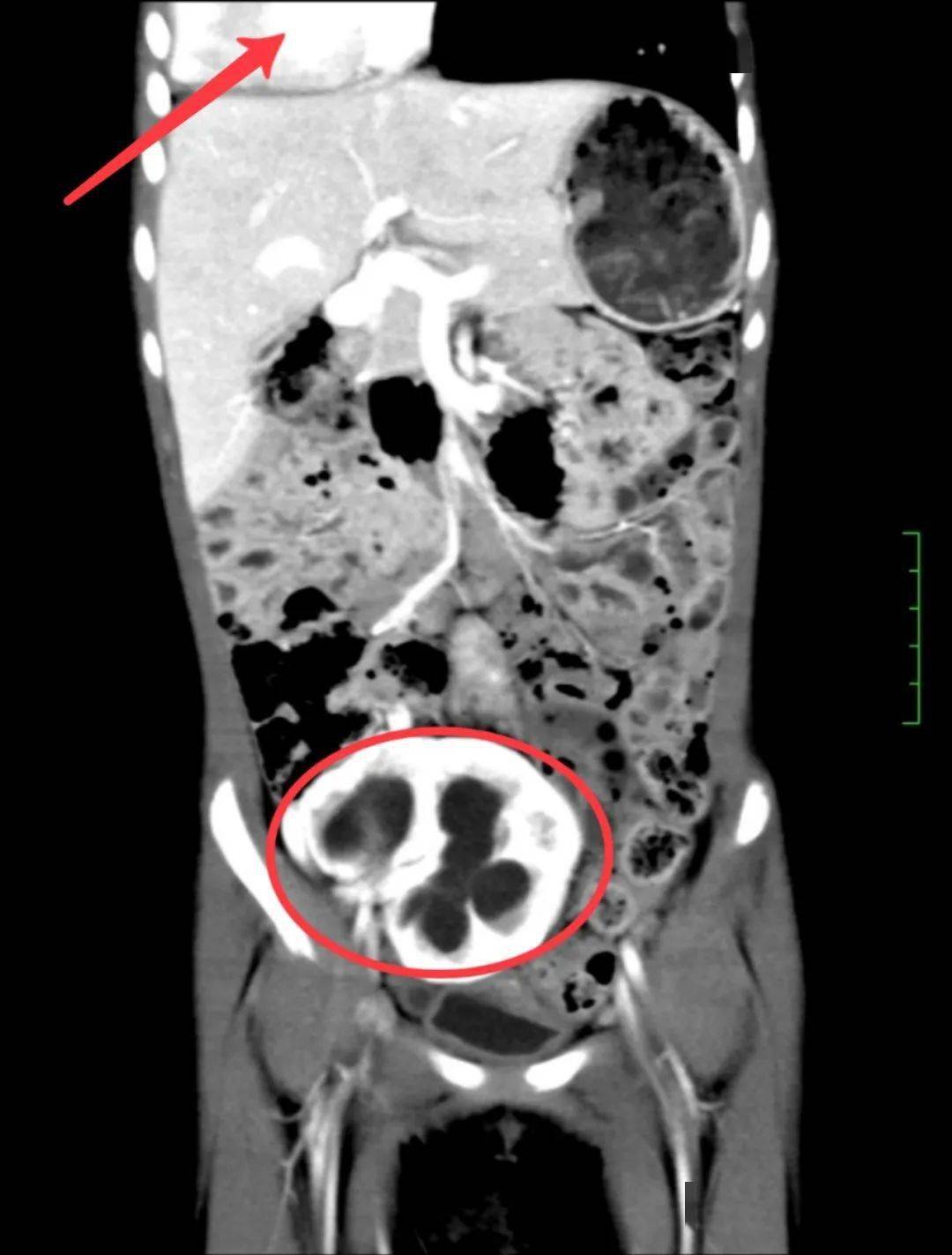 膀胱|5岁女童少了一个肾一侧肺还“偏心”，孤立肾和输尿管“走错路”“嘘嘘”不受控