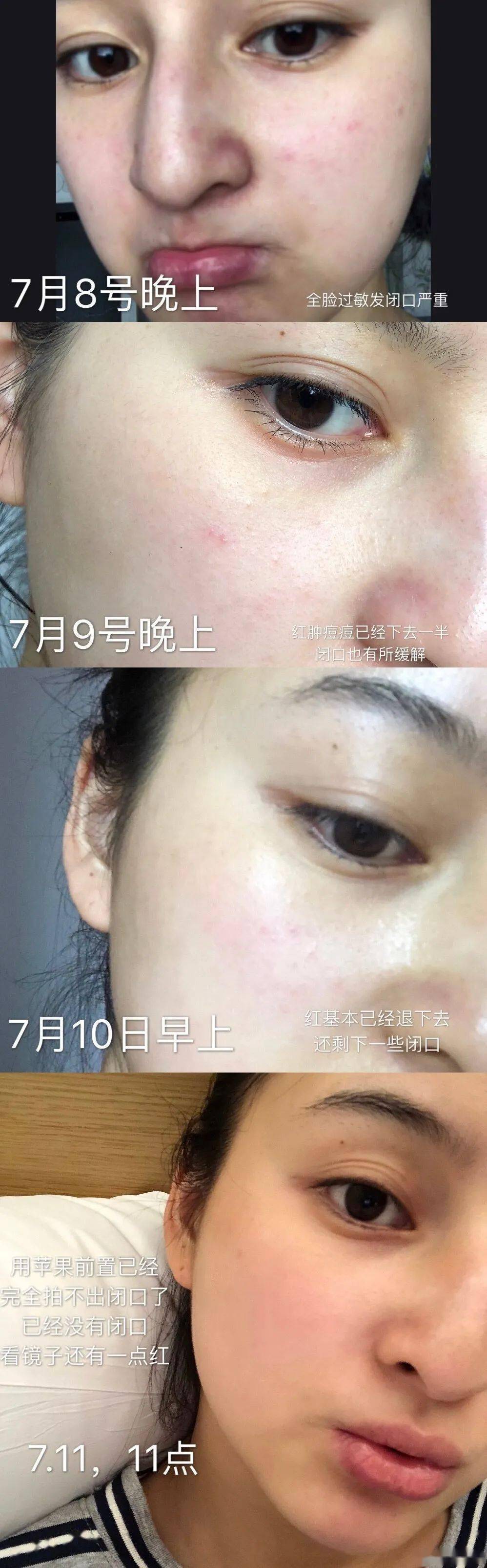 皮肤|刷酸=换脸？这个明星们超爱的百元刷酸好物搞定你的痘痘、闭口、黑头毛孔粗大还不怕烂脸！