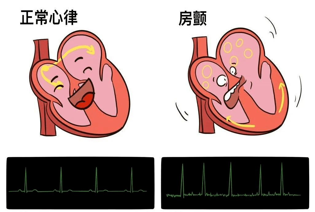 【注意】心脏乱跳,当心因为这病猝死?