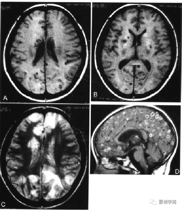 脑实质内囊性病变影像表现_囊虫