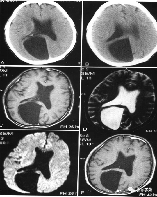 脑实质内囊性病变影像表现_囊虫