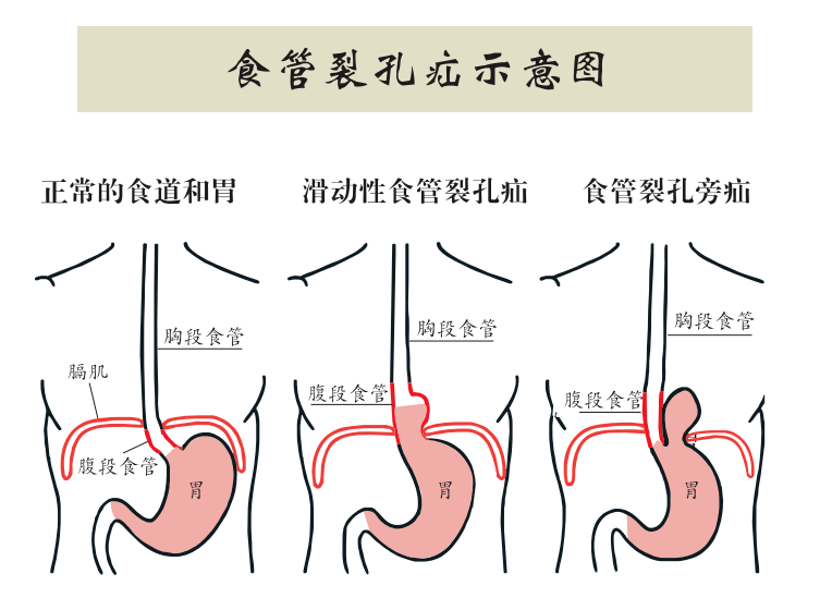 世界心脏日|胃,我想和你谈谈"心"