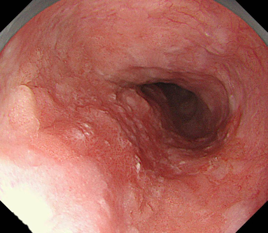 状微隆起的粗糙黏膜发现他食管中段有一在给蔡大爷做胃镜过程中腔镜