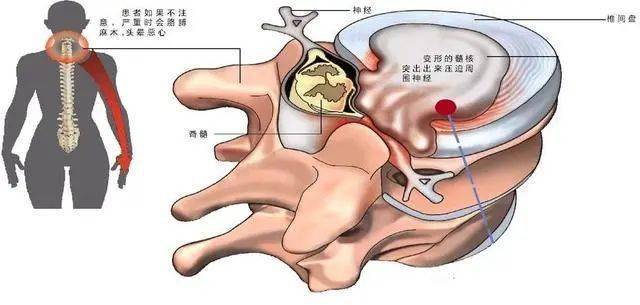 椎间盘突出压迫神经怎么办