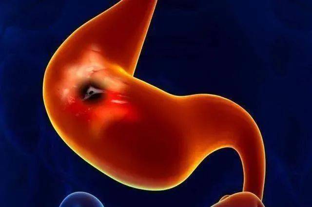 肾结石一般多大年龄 88be5e46aa8f40009d24b468db2e0772.jpeg