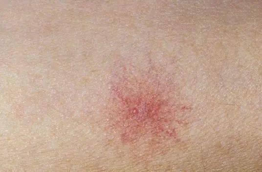 阑尾炎是哪一个地方疼 71dfe0069f66479281ef079f246d6c5a.jpeg