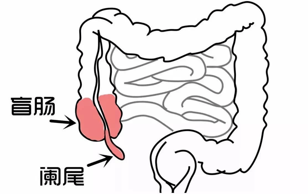 人人都可能遇上的阑尾炎,竟有致命危险!