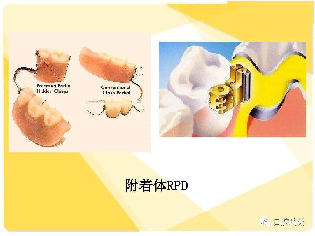 可摘局部义齿-结构