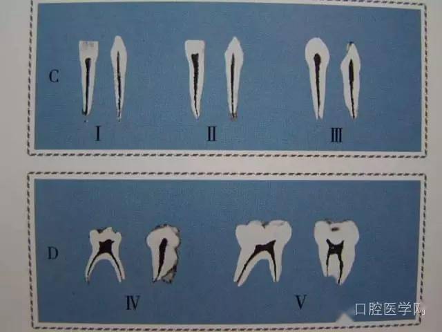 【多图】乳牙髓腔形态