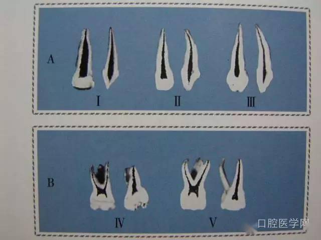 【多图】乳牙髓腔形态