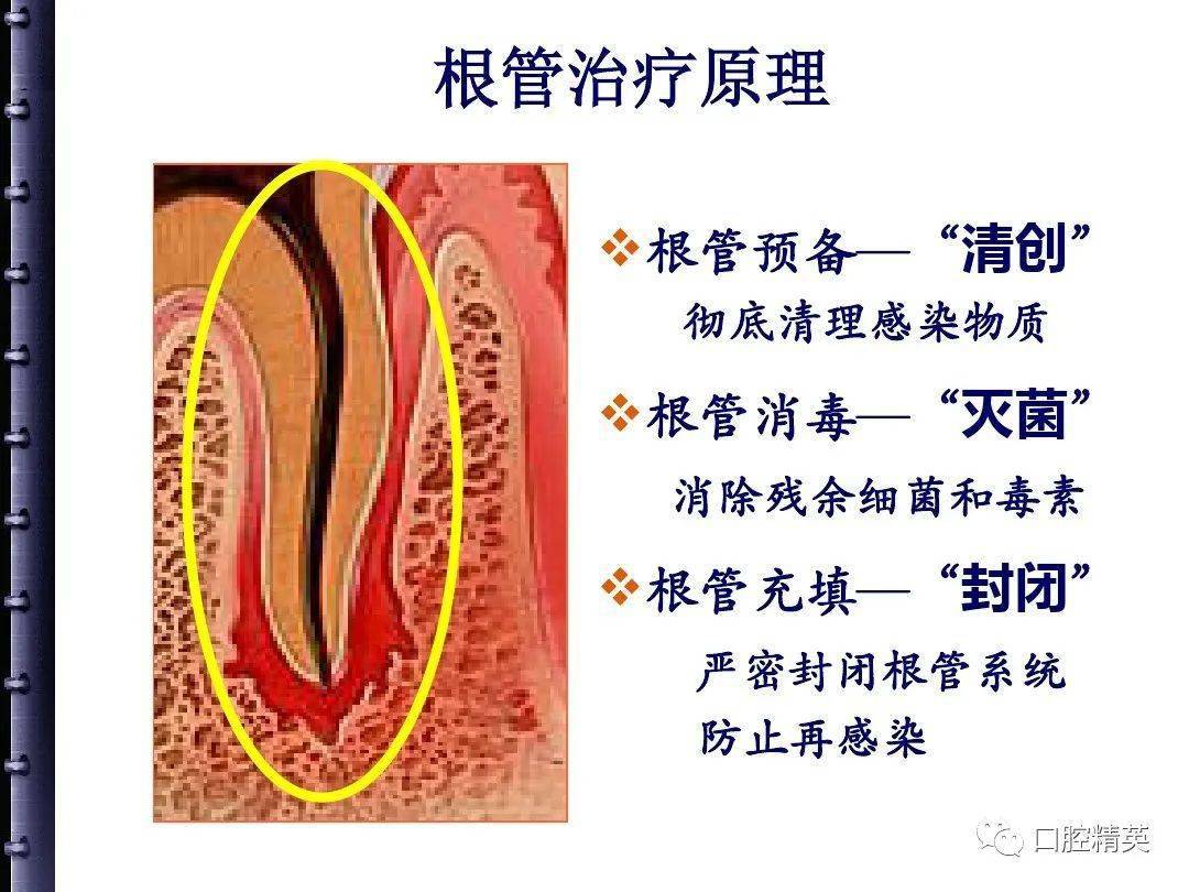 根管治疗的步骤,方法,器械