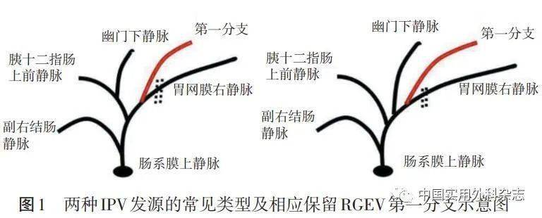 保留幽门胃切除术(pylorus-preserving gastrectomy,ppg)近年来逐渐