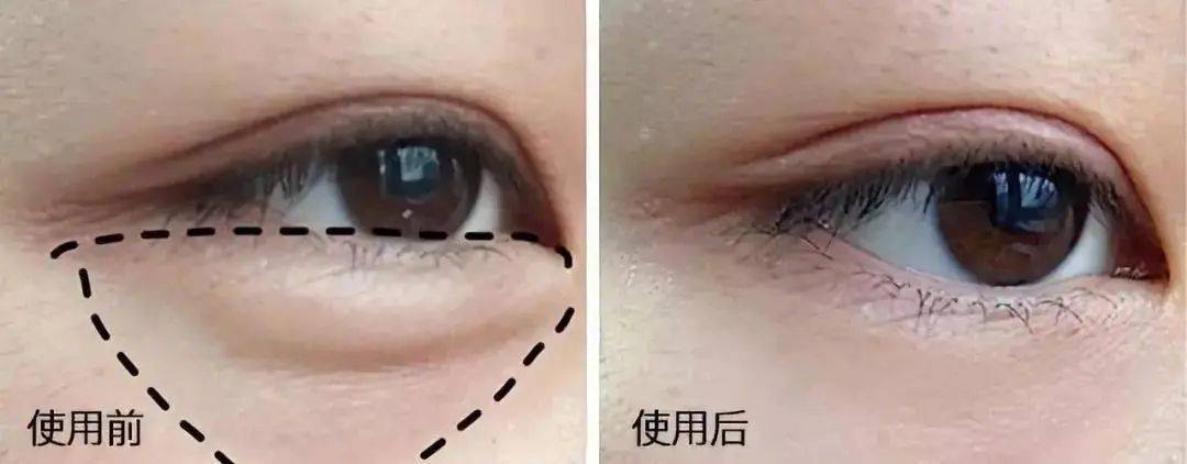 黑眼圈|430年的马应龙放大招,八宝古方做的眼霜,眼纹淡了