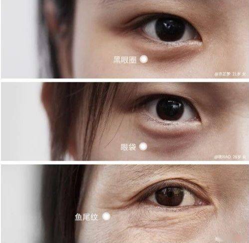 黑眼圈|430年的马应龙放大招,八宝古方做的眼霜,眼纹淡了