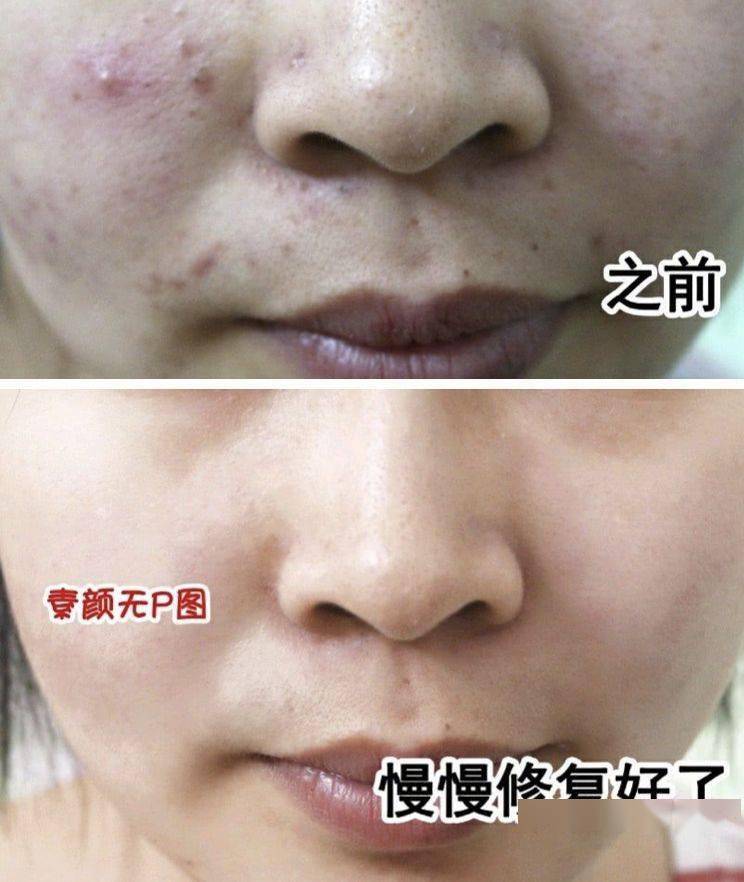 氨基酸|拒绝“螨虫脸”，5秒揉一揉，螨虫全出来了，痘痘黑头全没了！