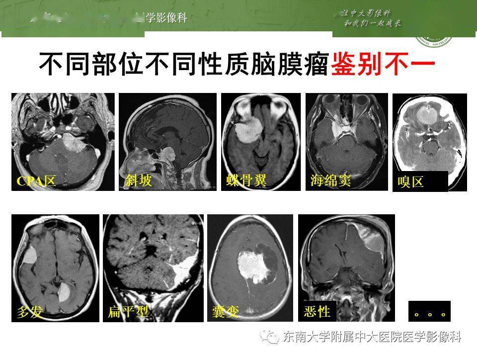 "脑膜尾征"你不会只知道脑膜瘤吧?