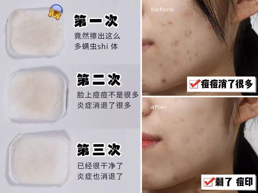 氨基酸|拒绝“螨虫脸”，5秒揉一揉，螨虫全出来了，痘痘黑头全没了！