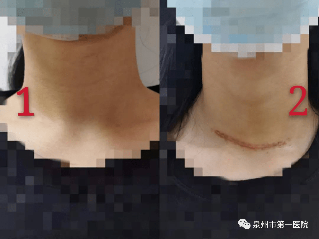 率先开展全腔镜腋窝入路甲状腺切除术,真正做到了