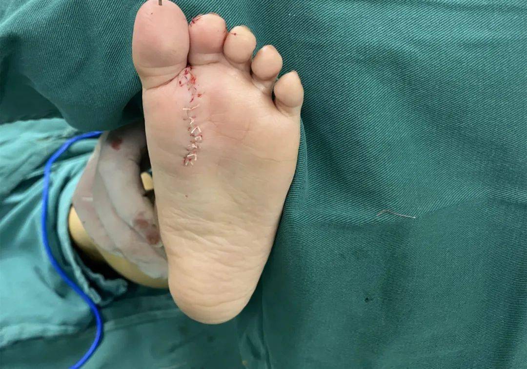淮安一2岁男童长了12个脚趾头,医生七小时手术复原