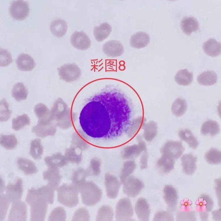 「嗜酸性中幼粒细胞」 形态特征:胞体较大,不规则形;胞质丰富,含有