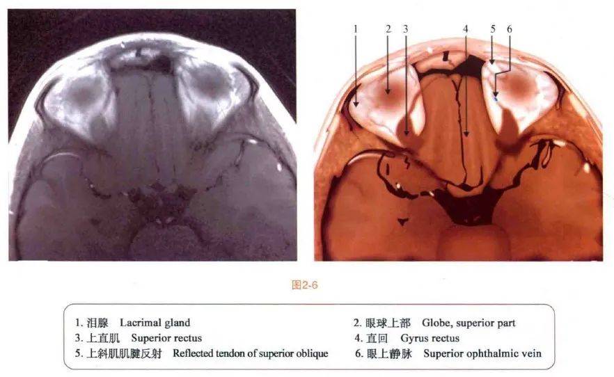 眼眶mri断层解剖速查图谱||眼科基础解剖精选图集