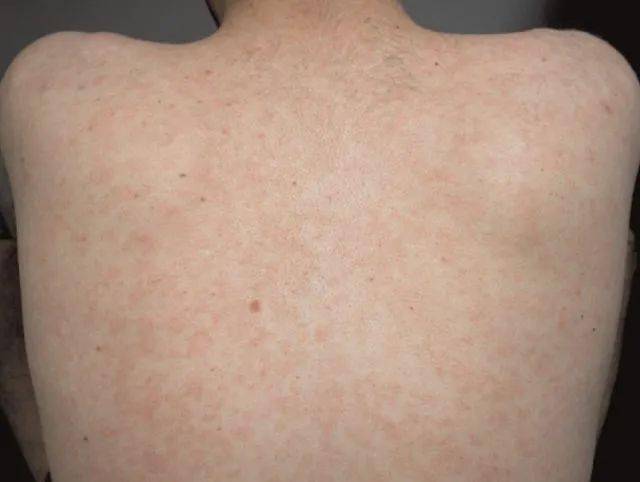 又称梅毒性玫瑰疹,是最常见的早期损害,好发于躯干和上肢,面部不受累
