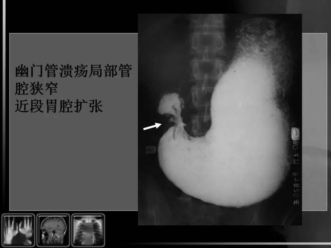 汇总消化道疾病影像诊断与鉴别