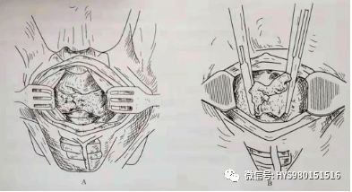 气管切开术的手术治疗要点难点解析