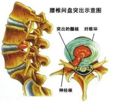 同样是坐,为什么有些人会腰间盘突出?可能是"作"出来的!