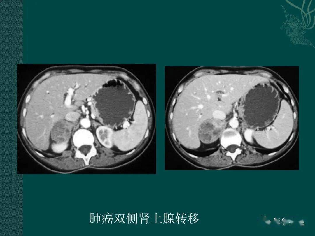 肾上腺占位病变影像诊断