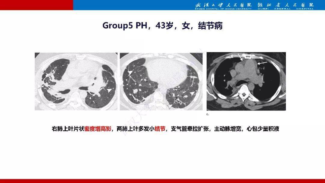 肺动脉高压临床分类及ct表现