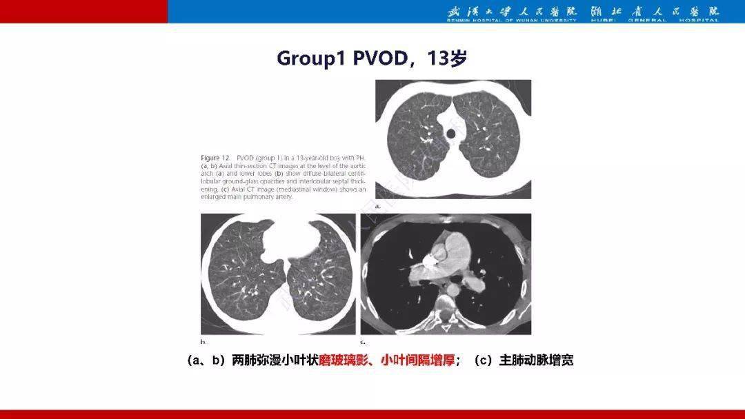 肺动脉高压临床分类及ct表现