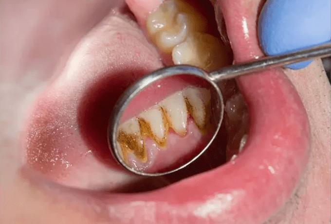 清洁|电动牙刷真的比普通牙刷好吗？我替你们问了医生