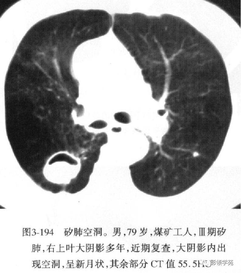 空洞发生在进行性尘肺融合块的基础上,常合并肺结核.